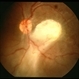 Toxocariasis